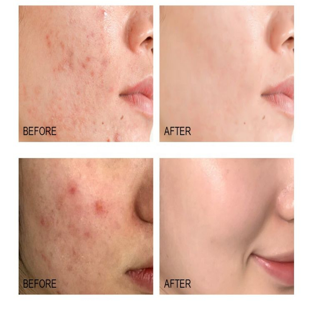 huyết thanh trị mụn